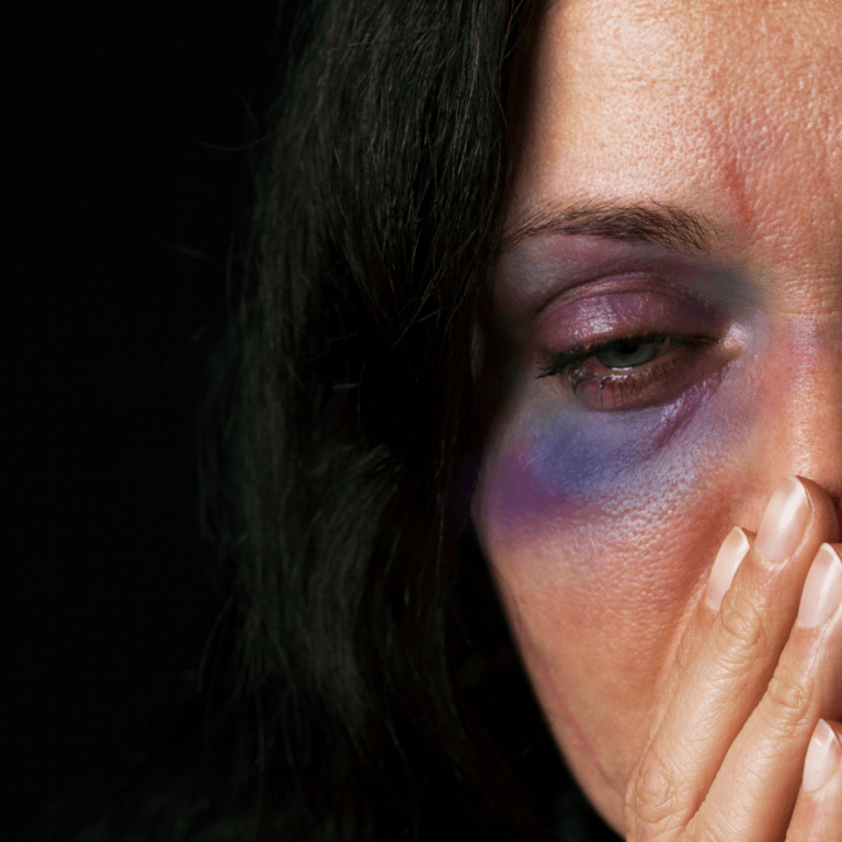 A woman with bruising around her left eye and scratches on her face